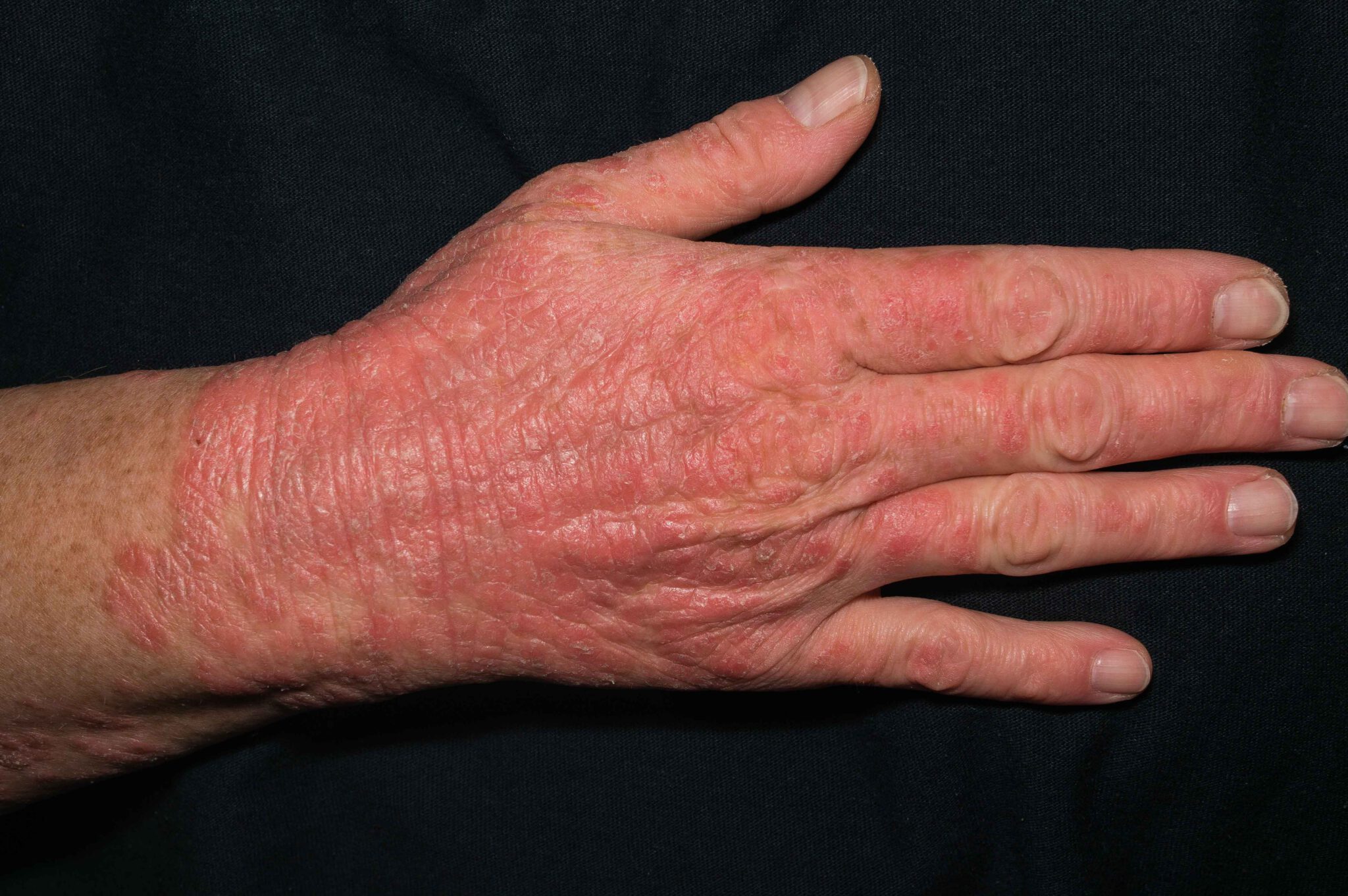 Das Corona Handekzem Vorbeugung und Heilung DEJAYU